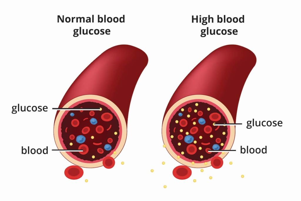 Natural Diabetes Management: How to Control Blood Sugar Without Medication